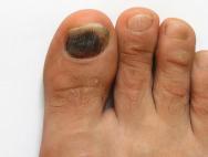 Почему чернеют ногти на ногах: причины и лечение