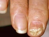 Препараты и народные средства для лечения запущенной формы грибка ногтей на ногах Как лечить запущенный грибок ногтей на ногах